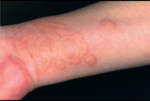 arm with hives rashes